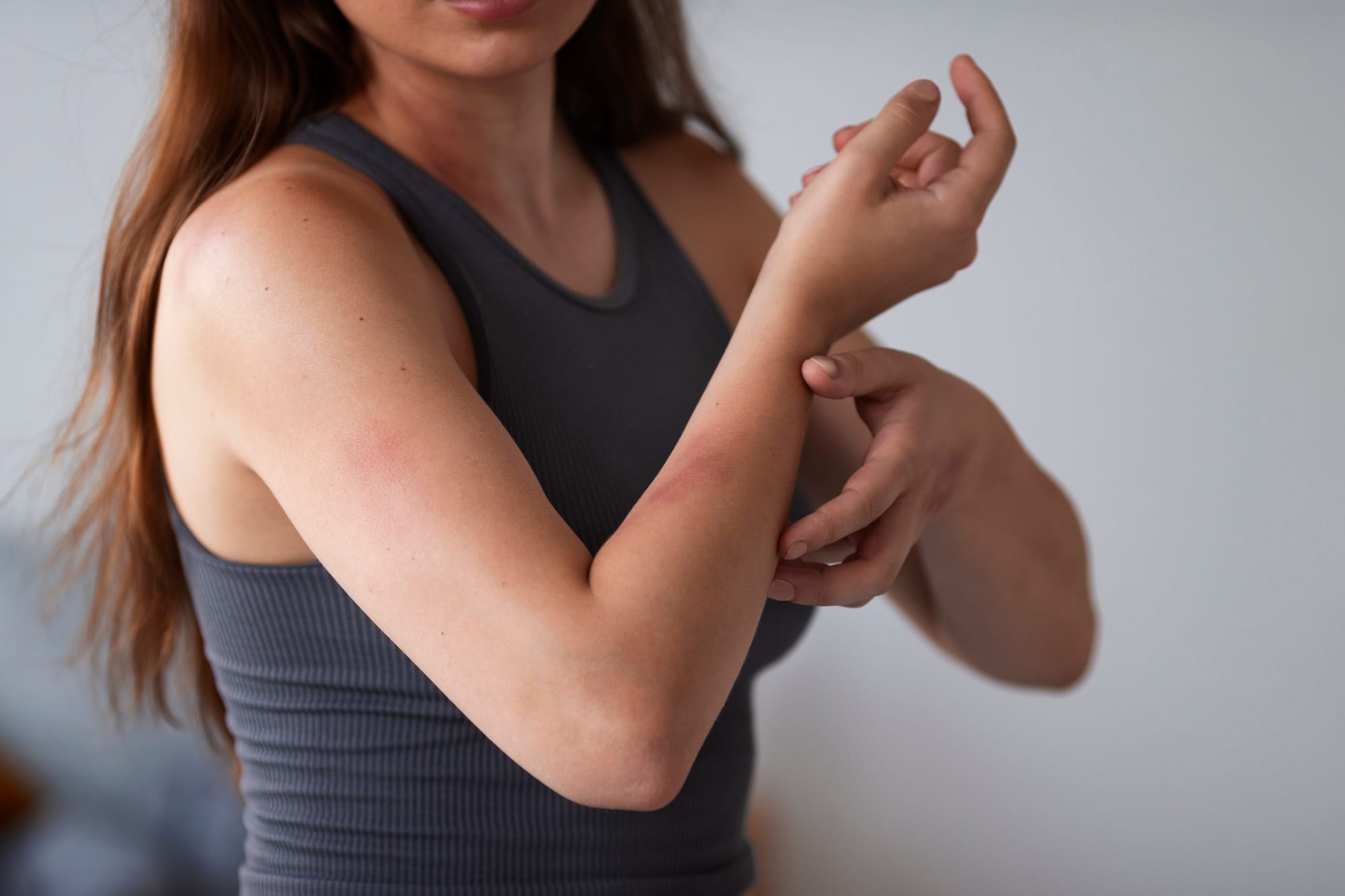 Urticaria por estrés conoce más sobre esta alergia nerviosa