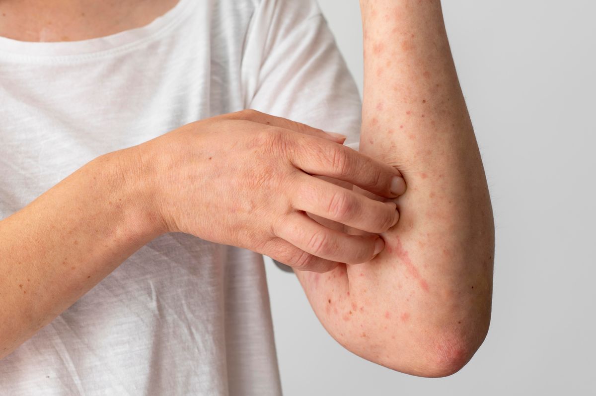 Alergia en la piel por estrés: Síntomas, causas y 5 consejos para aliviarla