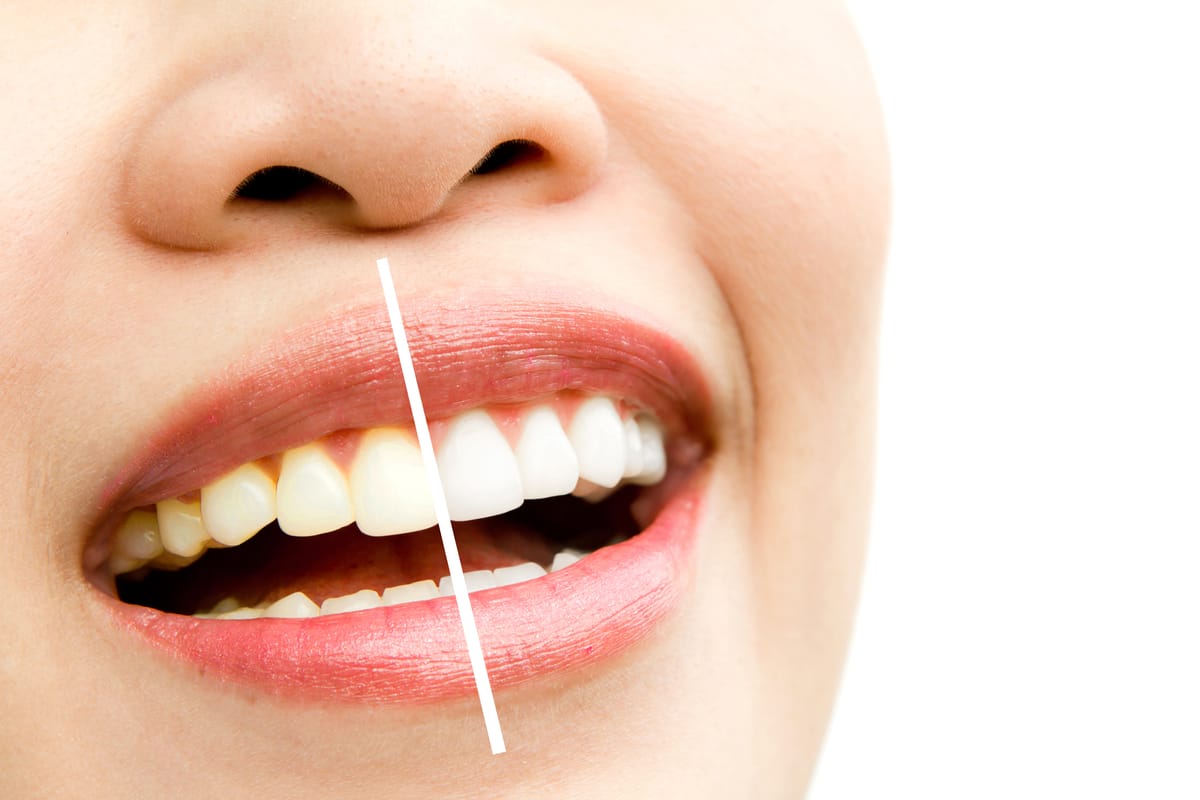 Aclaramiento o blanqueamiento dental ¿En qué consiste este procedimiento?